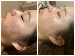 【🌸ミニモ学割🌸垢抜けたい女子必見‼️毛穴フェイシャル】毛穴の黒ずみ・角栓・ニキビケア👃🏼