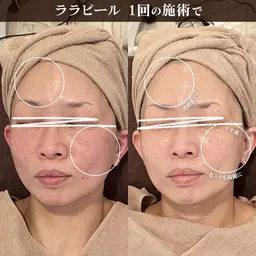 🌟ララピール【正規導入店】 韓国人気美容/ツヤ/美白  ¥16000→¥9200  (70分)