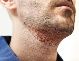 [メンズ脱毛カウンセリング]その場で完了1本処理の電気脱毛orIPL減退脱毛¥0