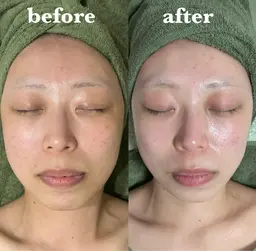 【美白･陶器肌】陶肌トリートメント▶¥8,800(陶肌パウダー1ｇプレゼント価格)