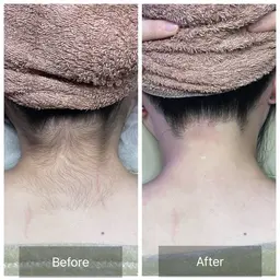 【✨️うなじ＋背中セット脱毛✨️】女性限定🎀夏に向けて後ろ姿まで美人へ✨️