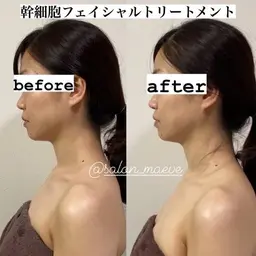 【極上の美肌エッセンス導入付】－5歳肌♪フェイシャルトリートメント