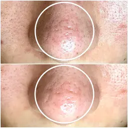 【モニター様】毛穴ケアコース　条件あり（補足説明をご覧ください）