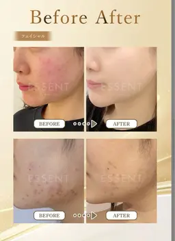 IPL光フェイシャルと保湿導入♪お顔のくすみに。肌荒れ、ニキビ、赤みにお悩みの方におすすめ♪