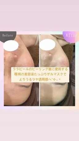 速攻トーンアップ◎美肌に感動🫶韓国美容NO.1❤️韓国肌管理【ララピール】🩷肌を剥かずに育てる肌育ピーリング⭐️