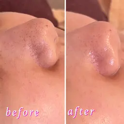 【鼻角栓・黒ずみ除去強化】全顔吸引+鼻ピーリングで引き締め肌に★