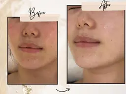 乳酸ピーリング（LAピール）のみ(顔出しなし撮影）