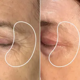 蓄熱式超音波!✨年齢を感じるたるみに最適!!その場でリフトアップを実感✨スキンケアも今までと同じではどんどん老けますよー