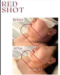 【韓国肌管理】【REDSHOT】韓国でブームの最先端施術!フェイスラインお試し!!
