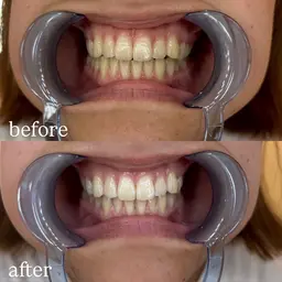 セルフホワイトニング（10分×3照射）初回限定価格