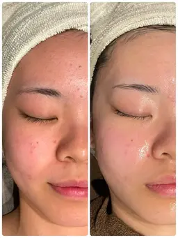 平日限定✨当店No.1✨バイオセルショット35➕ハイドロ(毛穴洗浄)