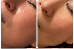 剥離なしハーブピーリング🌿.∘