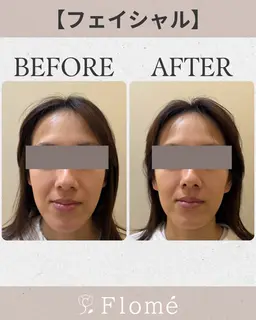 【フェイシャル】お顔からデコルテまで、アフターケアにも⭐️(お顔からデコルテまで20分)機械でアプローチ