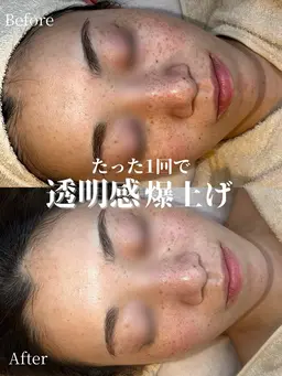 剥離なしハーブピーリング🌿毛穴/黒ずみ/くすみ