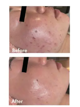 ❄️ホワイトスノーピール❄️