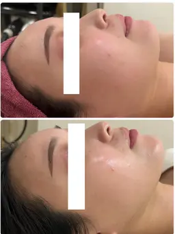 U24学生様限定価格❄️（最新小顔フォト人気Ｎｏ1）これをやれば間違いなく褒められてる肌へ☺️是非一度お任せください！