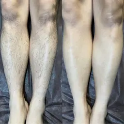 【VIO・顔・背中・両腕・両足】から好きな部位 2箇所 ¥5,800