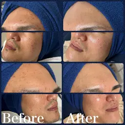 ✨メンズ限定✨ごっそり角質ケアフェイシャル🫘💦/洗顔→ゴマージュ（角質取り）→美容液＆皮脂抑制クリーム→パック