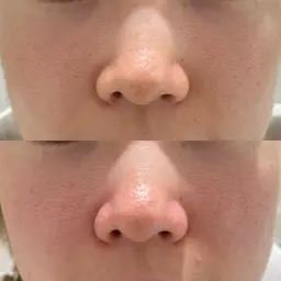 人気No.1⭐️ フェイシャル洗浄＋超音波深層洗浄⭐️毛穴の角栓・お肌のザラつき一度でつるピカ大実感💆‍♀️✨約30分