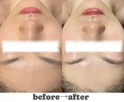 🤎川崎/駅近🤎バレンタインスペシャル✨透明感のある肌へ♪選べる毛穴洗浄or小顔マシン✨贅沢スキンケア￥2980