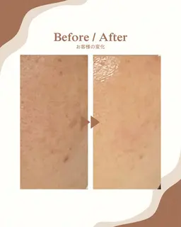 光フェイシャル✨ 12月27.28日限定❗️脱毛も‼️肌お肌悩みを一気に解決❗️毛穴改善・美白ケア・乾燥・肌荒れ改善