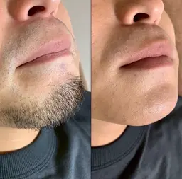 【メンズ】ヒゲ脱毛🧔‍♂️全顔照射　¥8,800→¥5,700✨　IPL脱毛✖️SHR脱毛のハイブリッドタイプ🌟