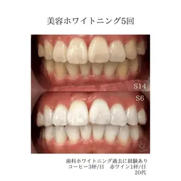 【初回お試し1.980円メニュー】美容ホワイトニング→不安な方向け