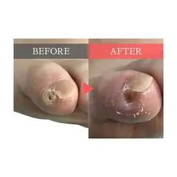 【副爪ケア1指＋爪切り】足の小指の爪横にある爪みたいなモノをキレイに取り除き、痛みや引っかかりを改善💁‍♀️