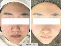【まずは】一時的でないニキビ根本改善◎ニキビ専門サロン・お肌無料相談