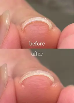 10名限定【ケア➕プレート】巻き爪ケア