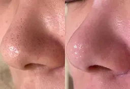 【写真(鼻のみ)掲載OKの方✨️】  毛穴洗浄➕ワックス (鼻＋毛穴の気になる部位)  全顔パック🌿