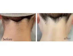 【地域最安値】【先着15名様→残り9名様】全身脱毛（顔＋VIO込）