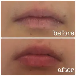 【エステ】リップエステ👄