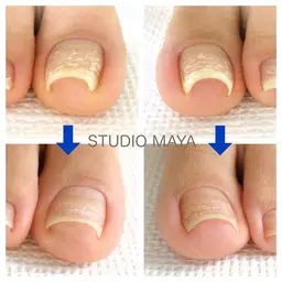 【foot】巻き爪ケア/BSブレイス【巻き爪・陥入爪補正】