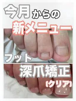 フット深爪矯正【長さ出し】◆クリア◆(オフ込/フットバス付) むしったり 割れたり 小さくなった爪も綺麗な状態に✧︎