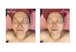 光フェイシャル✨✨ たるみ、シミくすみが気になる方へ。首、肩、デコルテマッサージ付