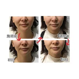 光フェイシャル初回お試し価格（顔​〜​首まで）　シワ　たるみ　くすみ　　シミ　ニキビ跡　毛穴悩みに