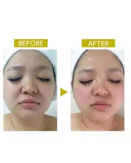 結果重視🌈満足度No1🌟毛穴洗浄×ラジオ波小顔マッサージ×お悩みに合わせたポレーション導入❤️モニター様