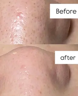 【新規】全顔毛穴洗浄40分  　［ニキビ/肌荒れ/毛穴の黒ずみ、開き/角栓/ゴワつき/肌質改善］