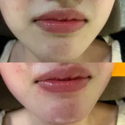 【お肌ツルツル】 フェイシャルWAX脱毛‼︎美容液込☆