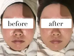 【劇的美肌再生】透明感×ハリ艶◎ルネセルピーリングで内側から輝く素肌へ🌟