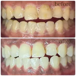 💐初めてのセルフホワイトニング💐　【平日１２時～１６時１日１名様限定】歯科提携💫ご新規様２照射1980円