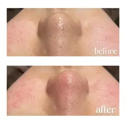 《黒ずみ/角栓/ニキビ/皮脂》高濃度VC◆水光艶肌ハイドロfacial🫧