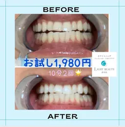 初めての方必見✨1回で効果抜群🌈🦷やって良かったの声多数✨ホワイトニングが今だけ1,980円❣️10分✖️2照射🌟