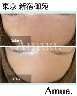 【モニター3回券】毛穴・頭皮洗浄付きハーブ 🌿ソフトorハード