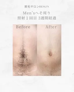 メンズ VIO+全身脱毛