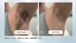 メンズワキ脱毛