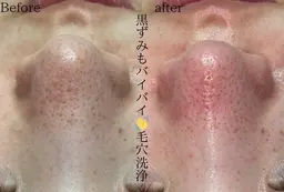 【初回限定】毛穴洗浄全顔コース　メンズにもおすすめ！