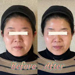 ファーマリジェネ深層美肌コース　50%オフ‼️20000円→10000円