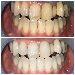 🦷セルフホワイトニング8分×2回🦷